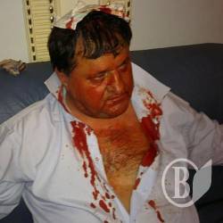Нардепівцю Петруку наклали 5 швів. За мову (Оновлено) Нардепівцю Петруку наклали 5 швів. За мову (Оновлено)
