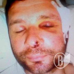 Жорстоко побито адвоката Поліни Малоштан Жорстоко побито адвоката Поліни Малоштан