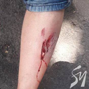 В Чернігові авто зламало ногу мотоциклісту В Чернігові авто зламало ногу мотоциклісту