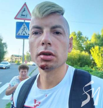 У Чернігові підступно побили блогера Ігоря Стаха У Чернігові підступно побили блогера Ігоря Стаха